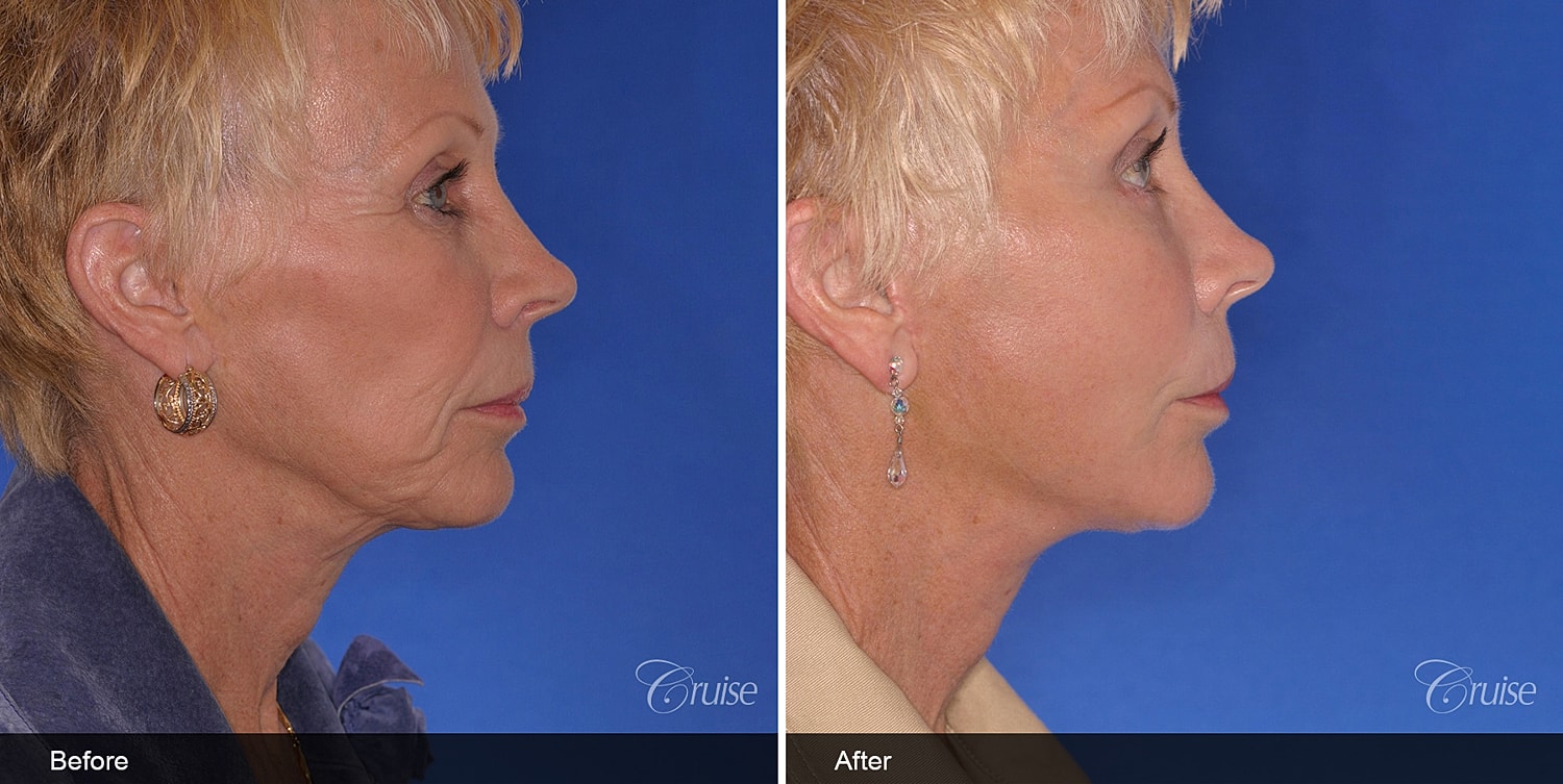 Neck Lift Before & After