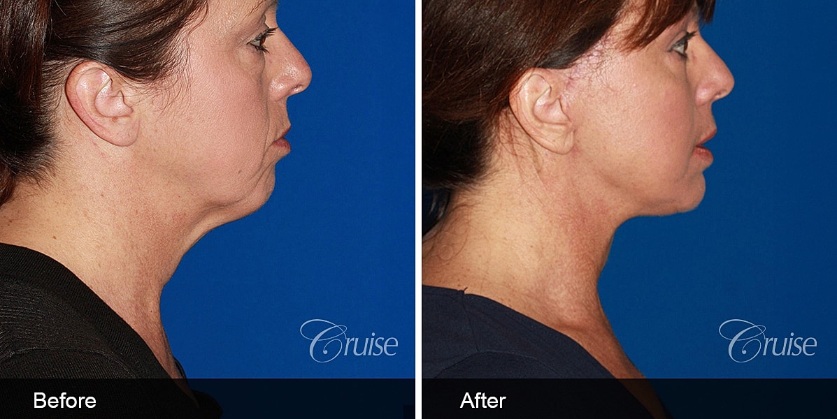 Neck Lift Before & After