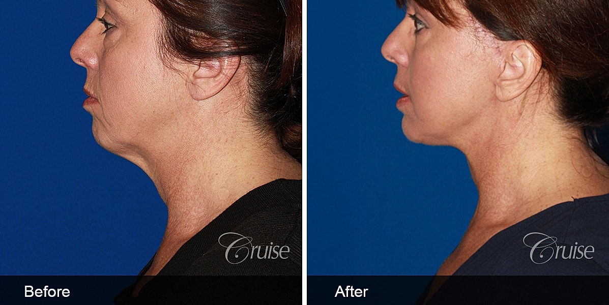 Neck Lift Before & After