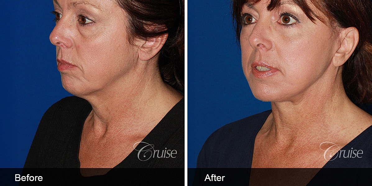 Neck Lift Before & After
