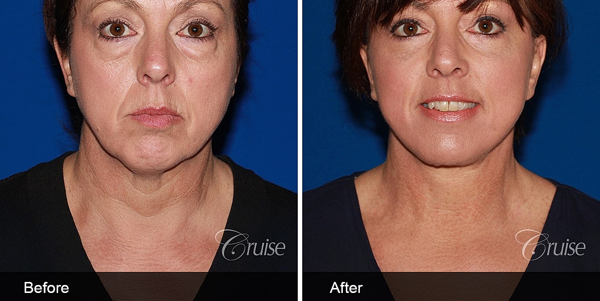 Neck Lift Before & After
