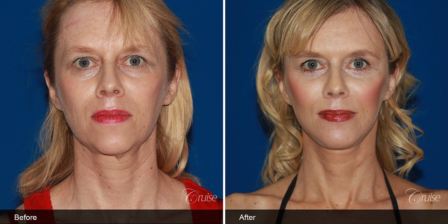 Neck Lift Before & After