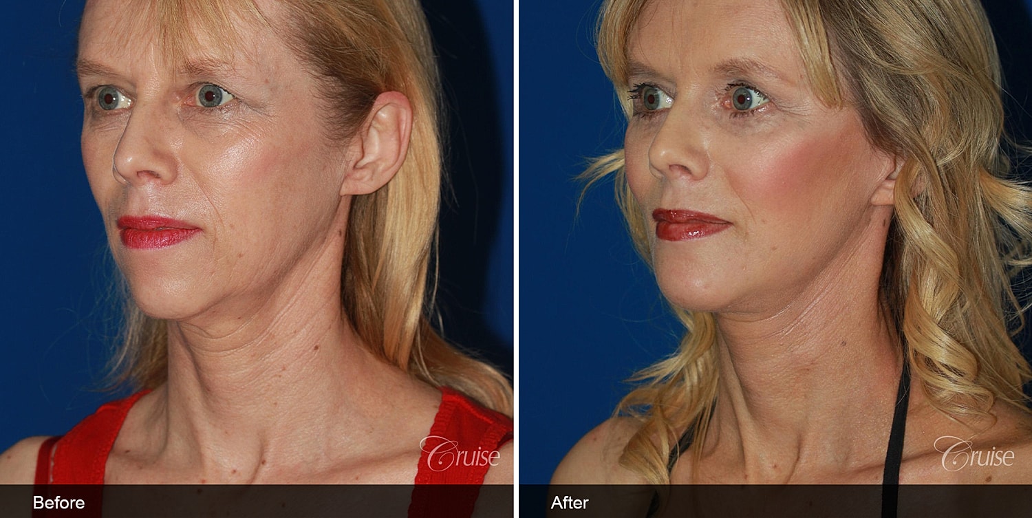 Neck Lift Before & After
