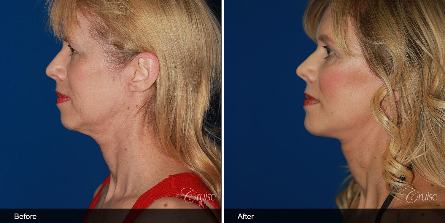 Neck Lift Before & After