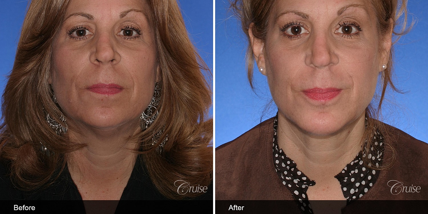 Neck Lift Before & After