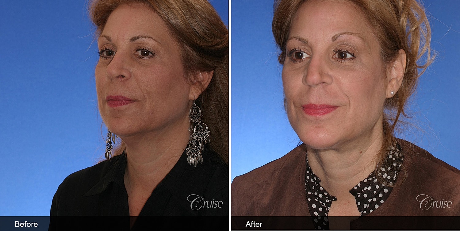 Neck Lift Before & After