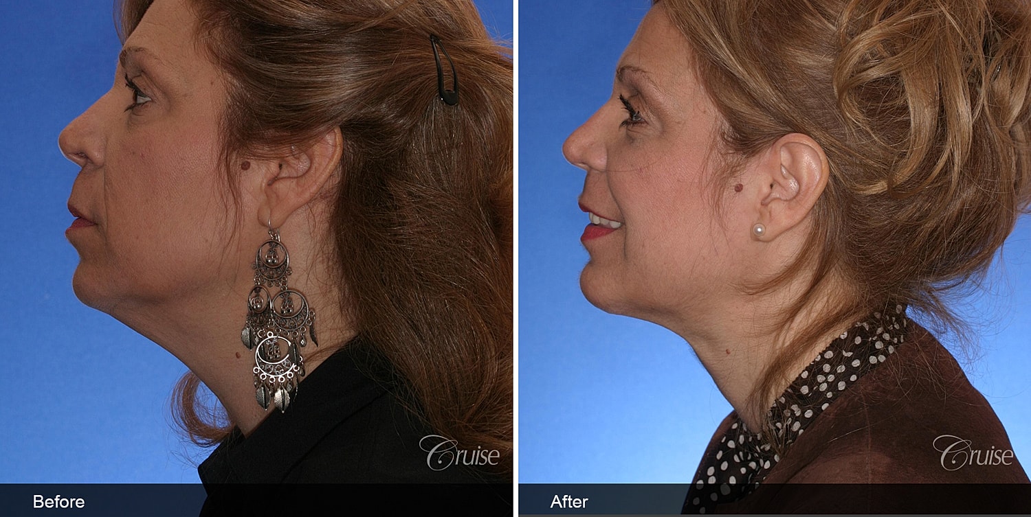 Neck Lift Before & After