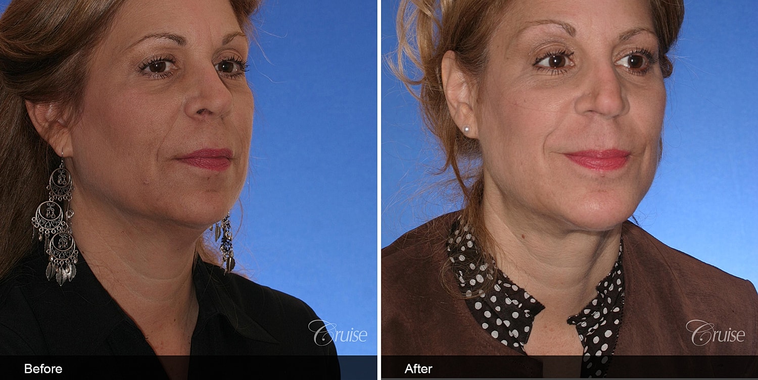 Neck Lift Before & After