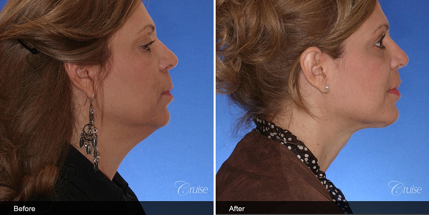 Neck Lift Before & After