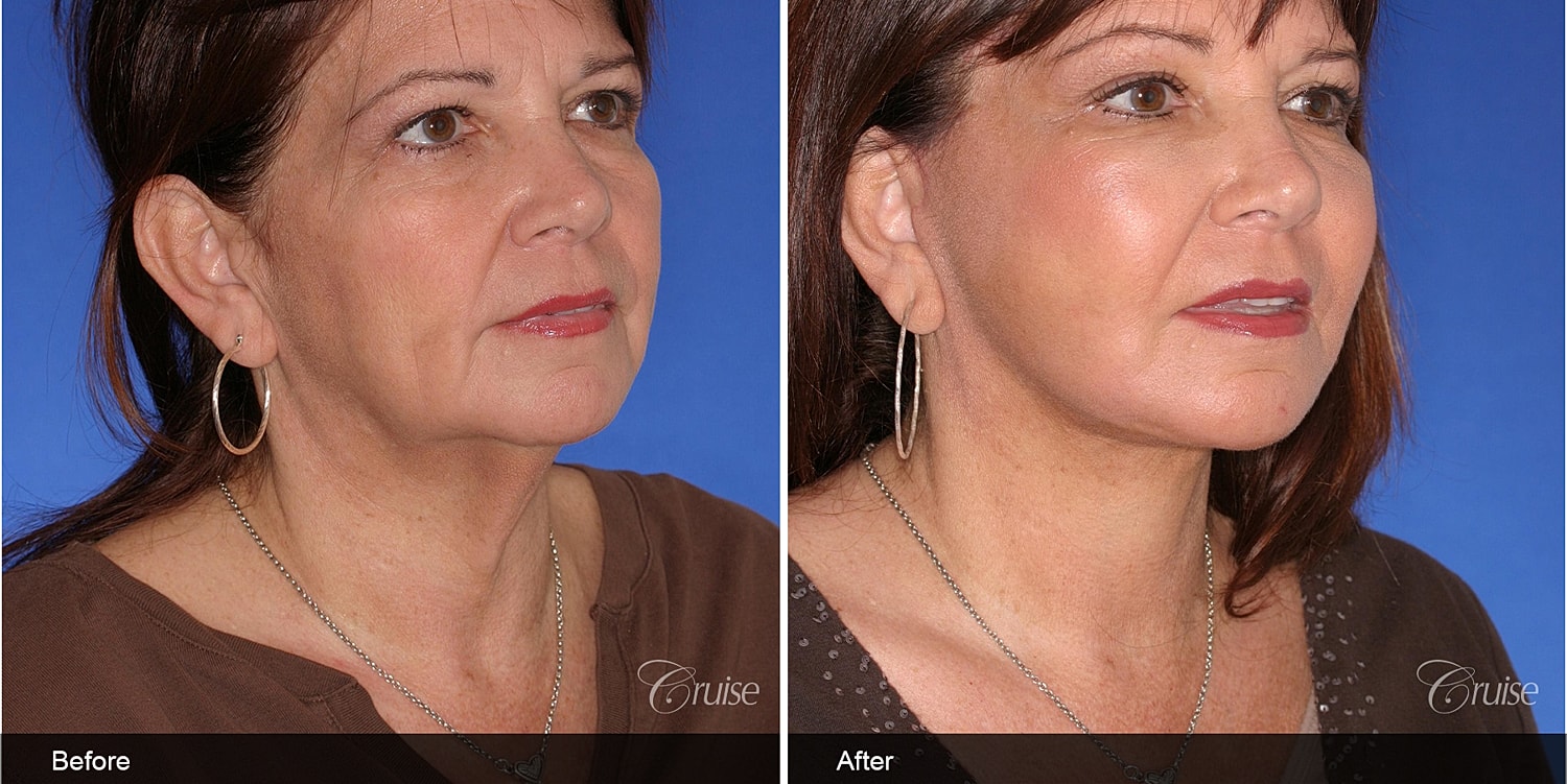 Neck Lift Before & After