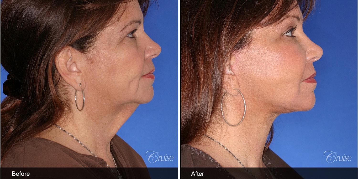 Neck Lift Before & After