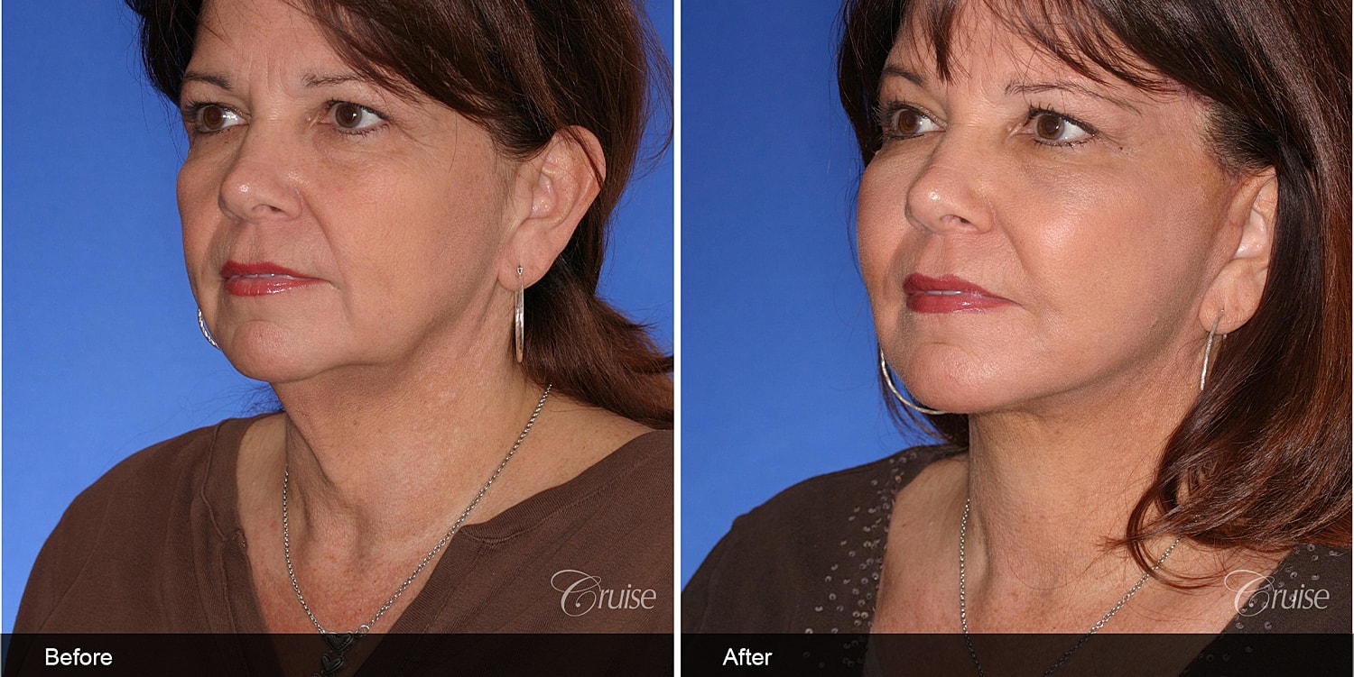 Neck Lift Before & After