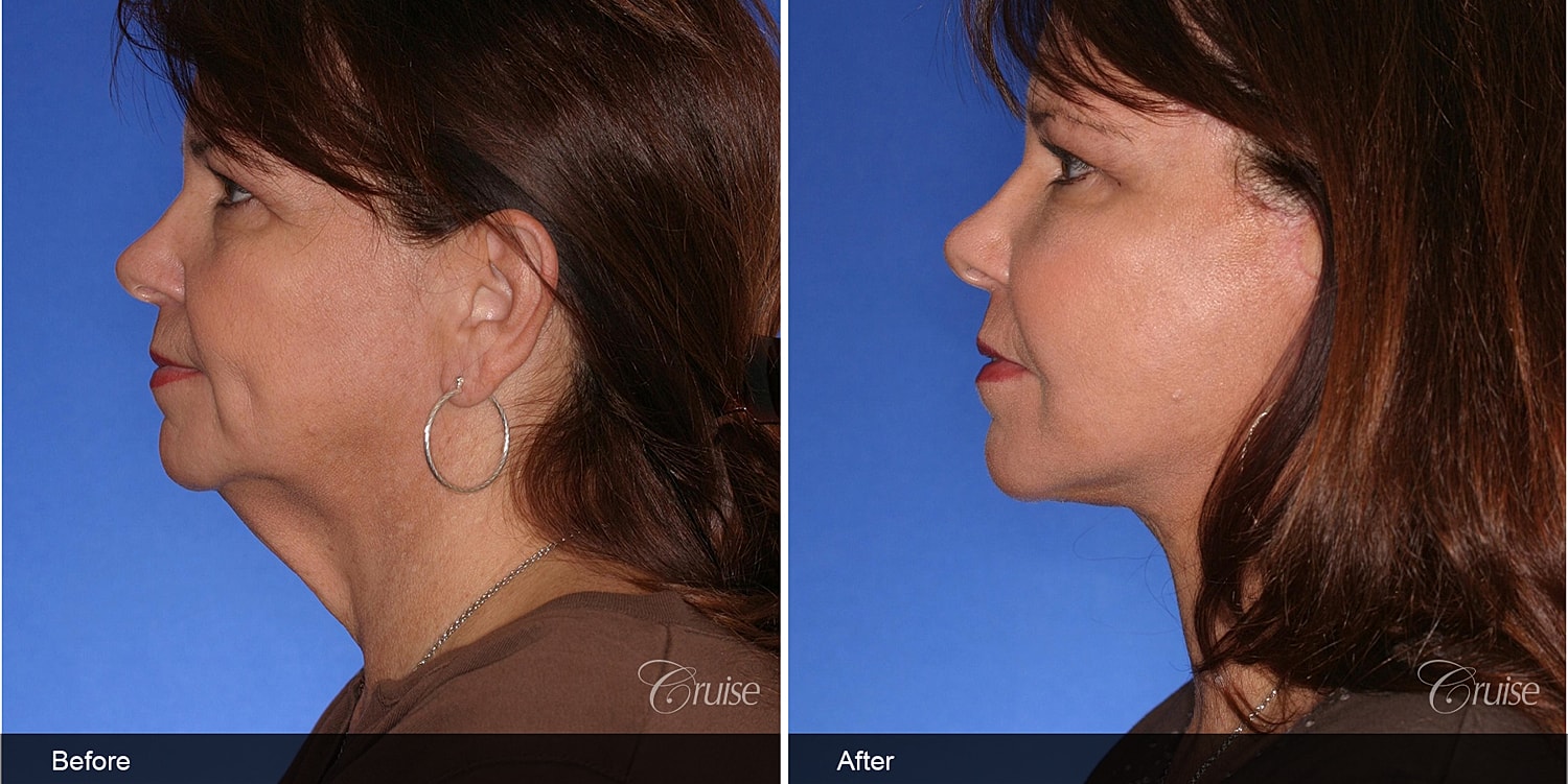 Neck Lift Before & After
