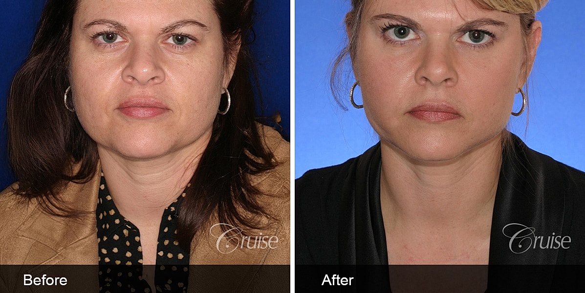 Neck Lift Before & After