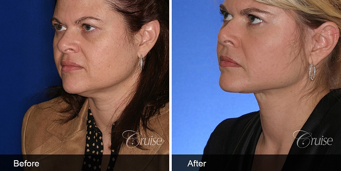 Neck Lift Before & After