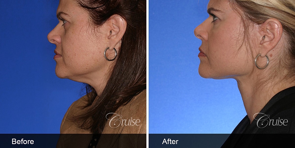 Neck Lift Before & After