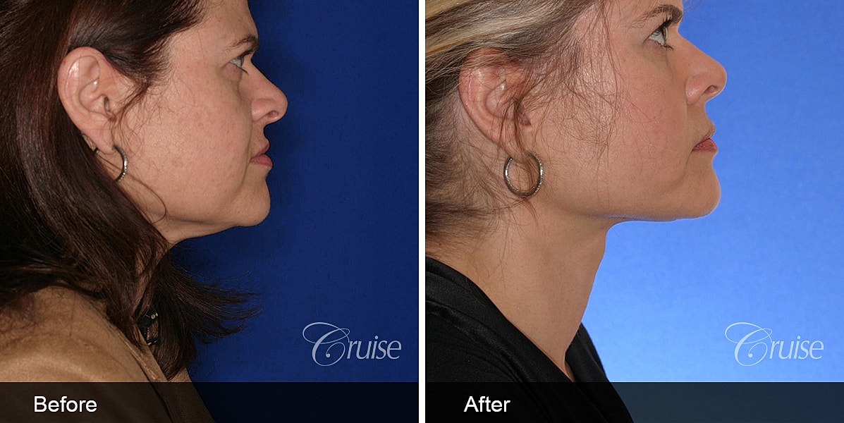 Neck Lift Before & After