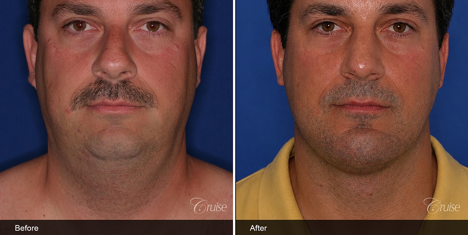 Neck Lift Before & After