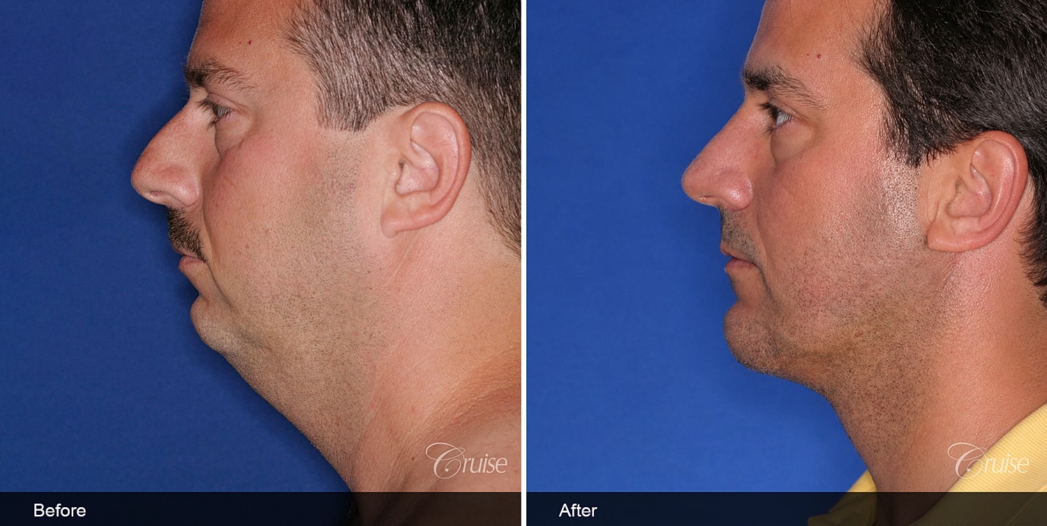 Neck Lift Before & After