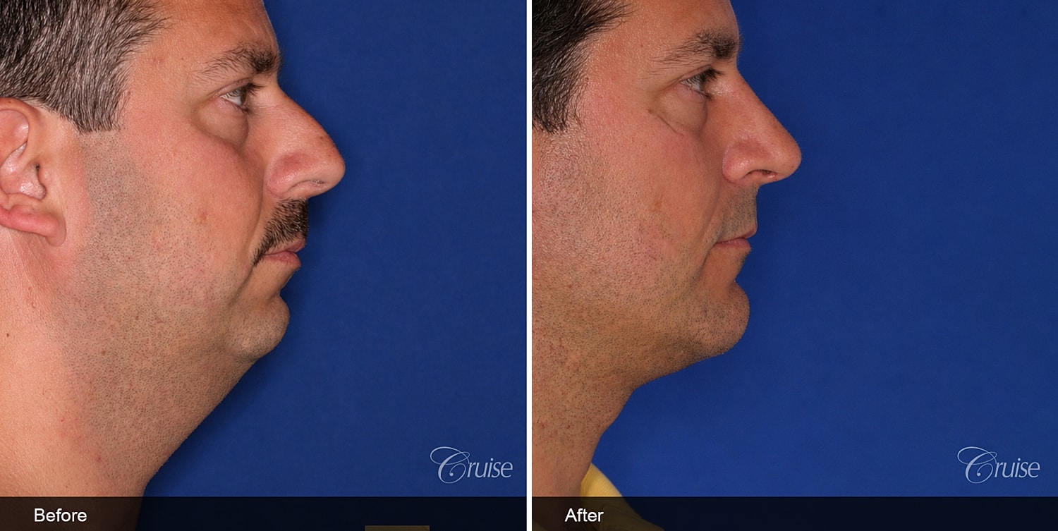Neck Lift Before & After