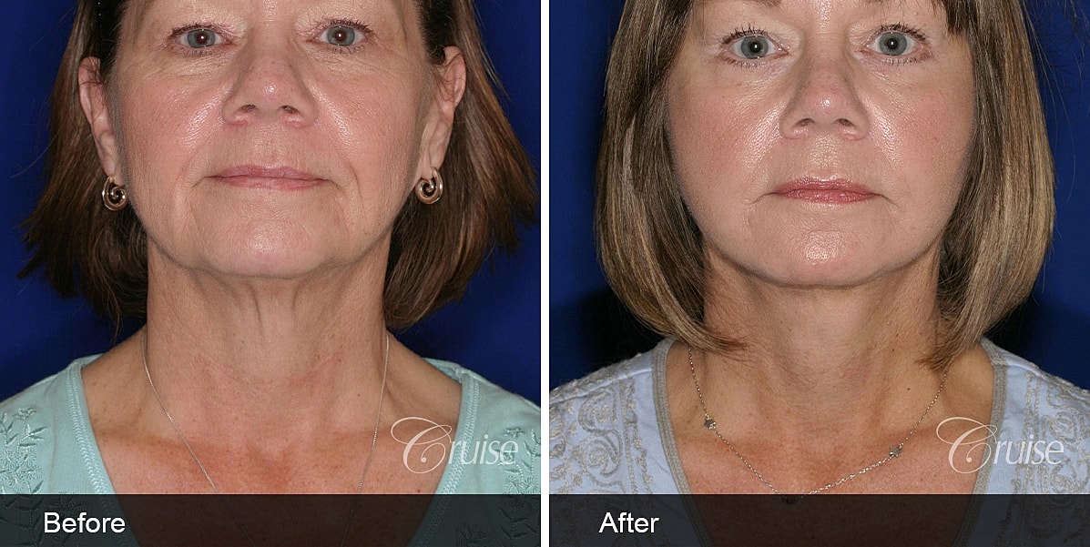 Neck Lift Before & After
