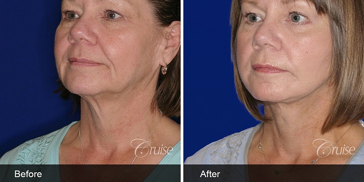 Neck Lift Before & After