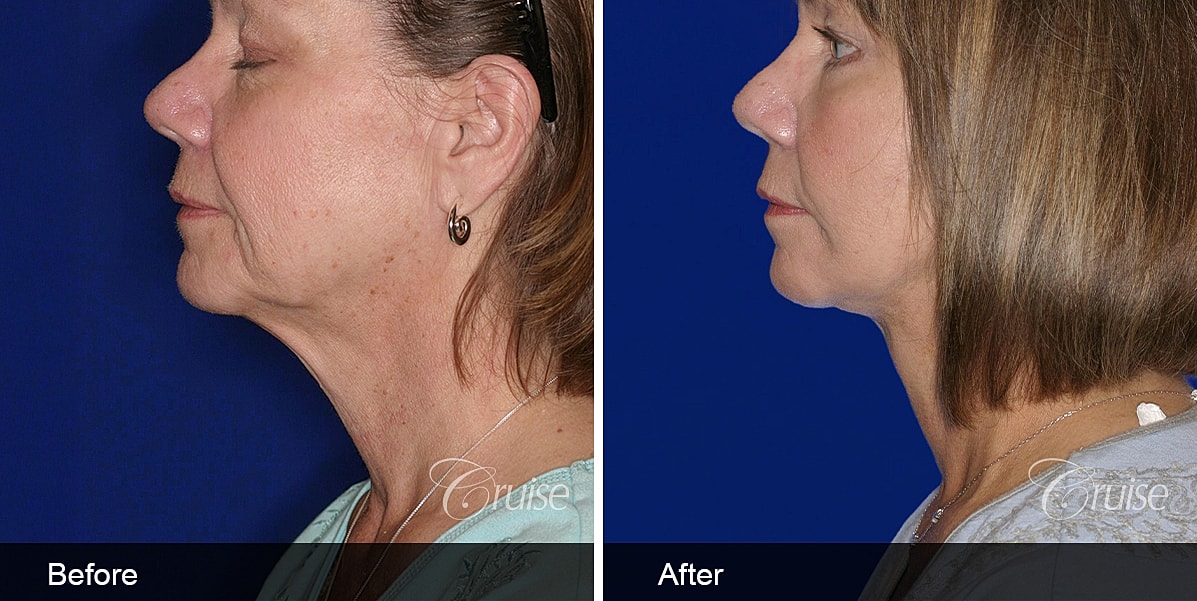 Neck Lift Before & After
