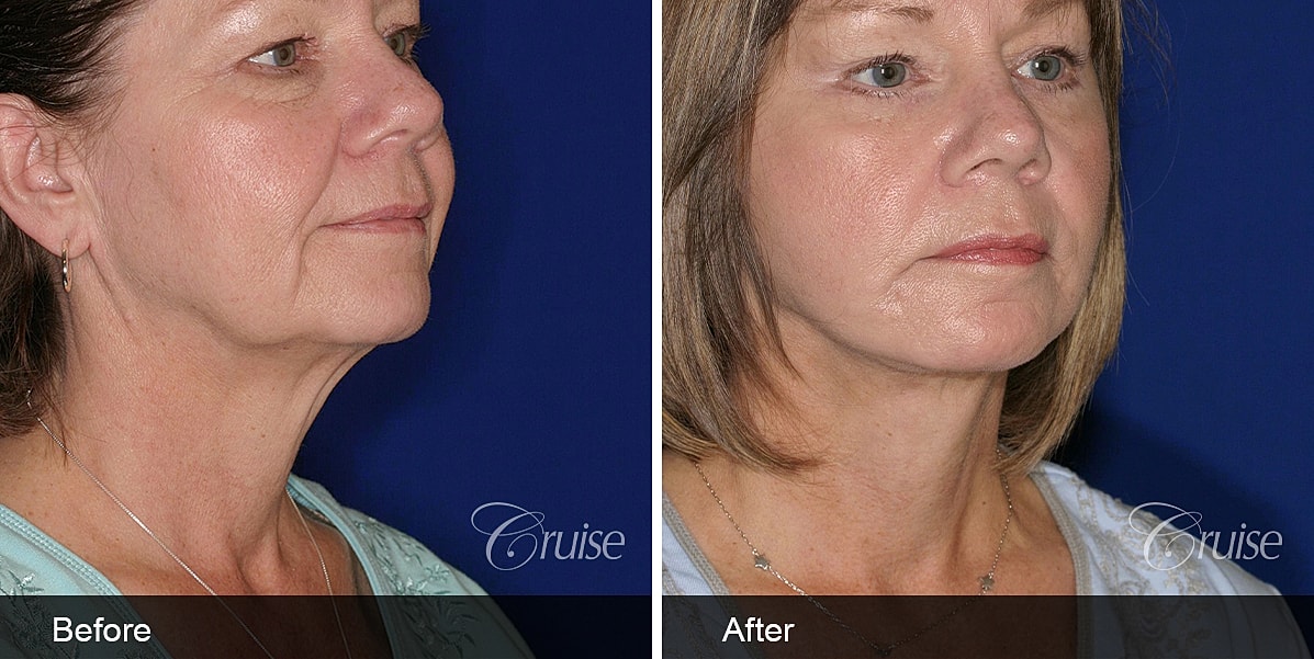 Neck Lift Before & After