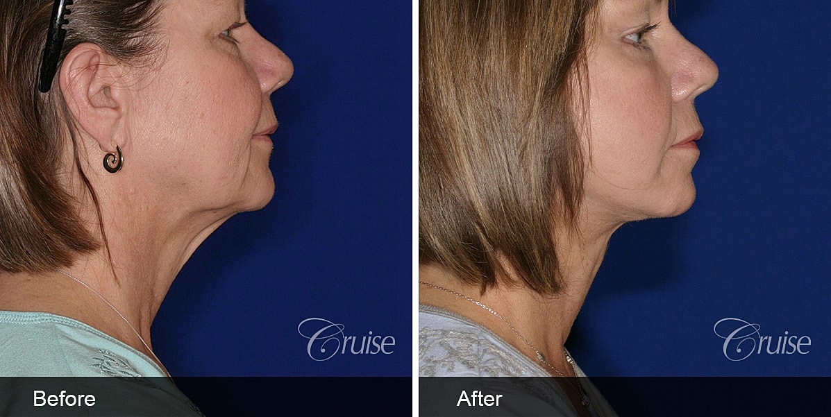 Neck Lift Before & After