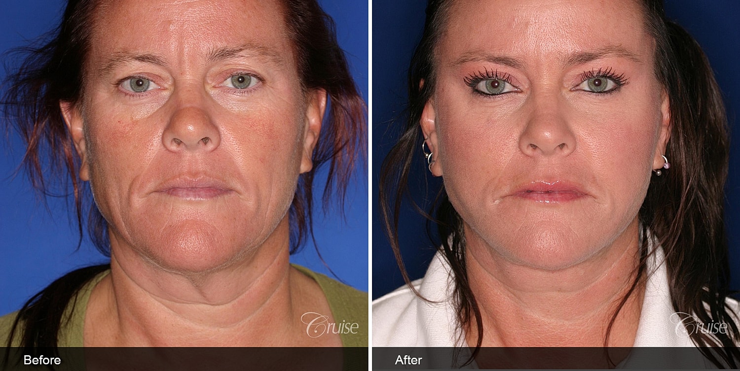 Neck Lift Before & After
