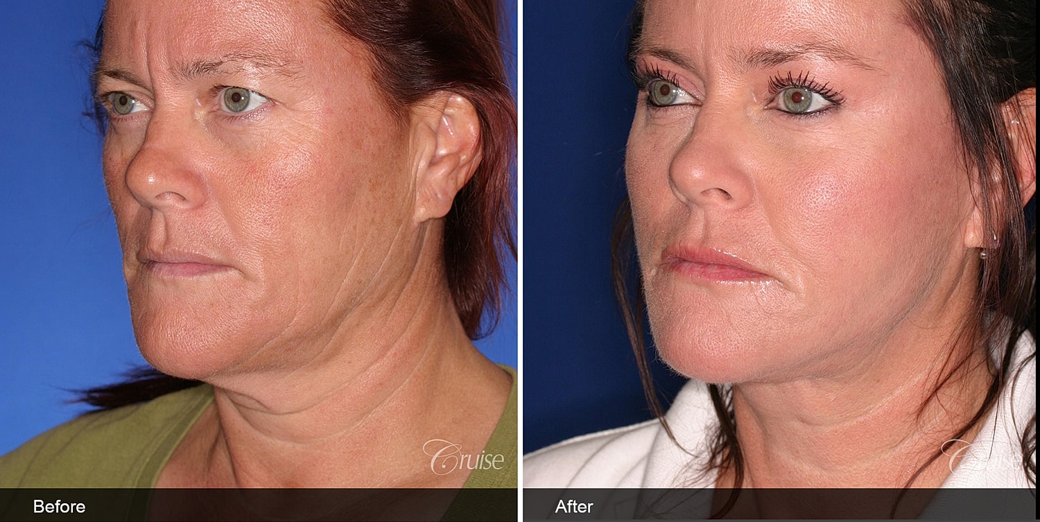 Neck Lift Before & After