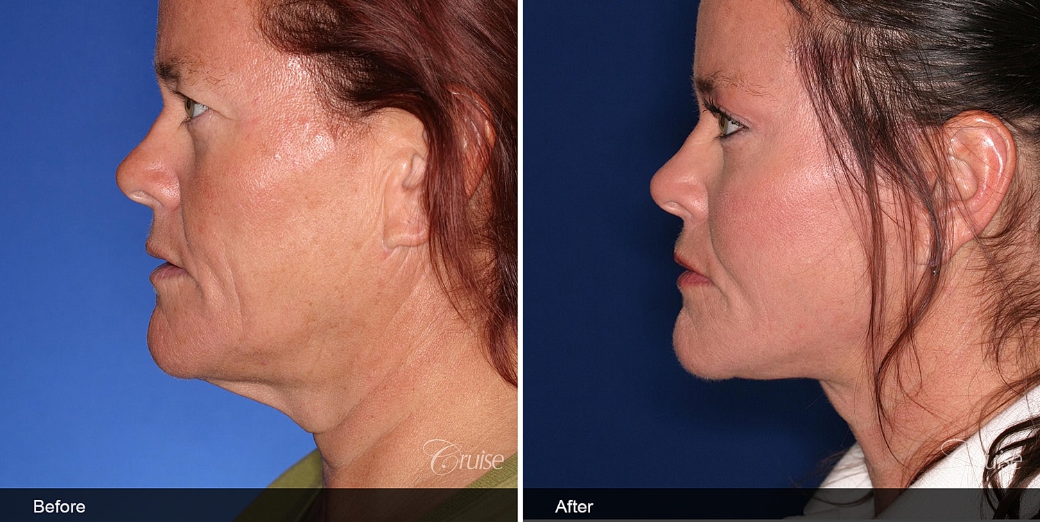 Neck Lift Before & After