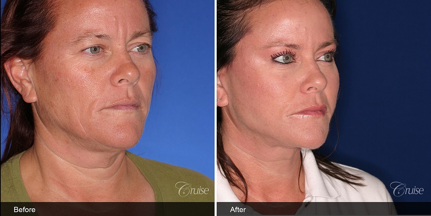 Neck Lift Before & After