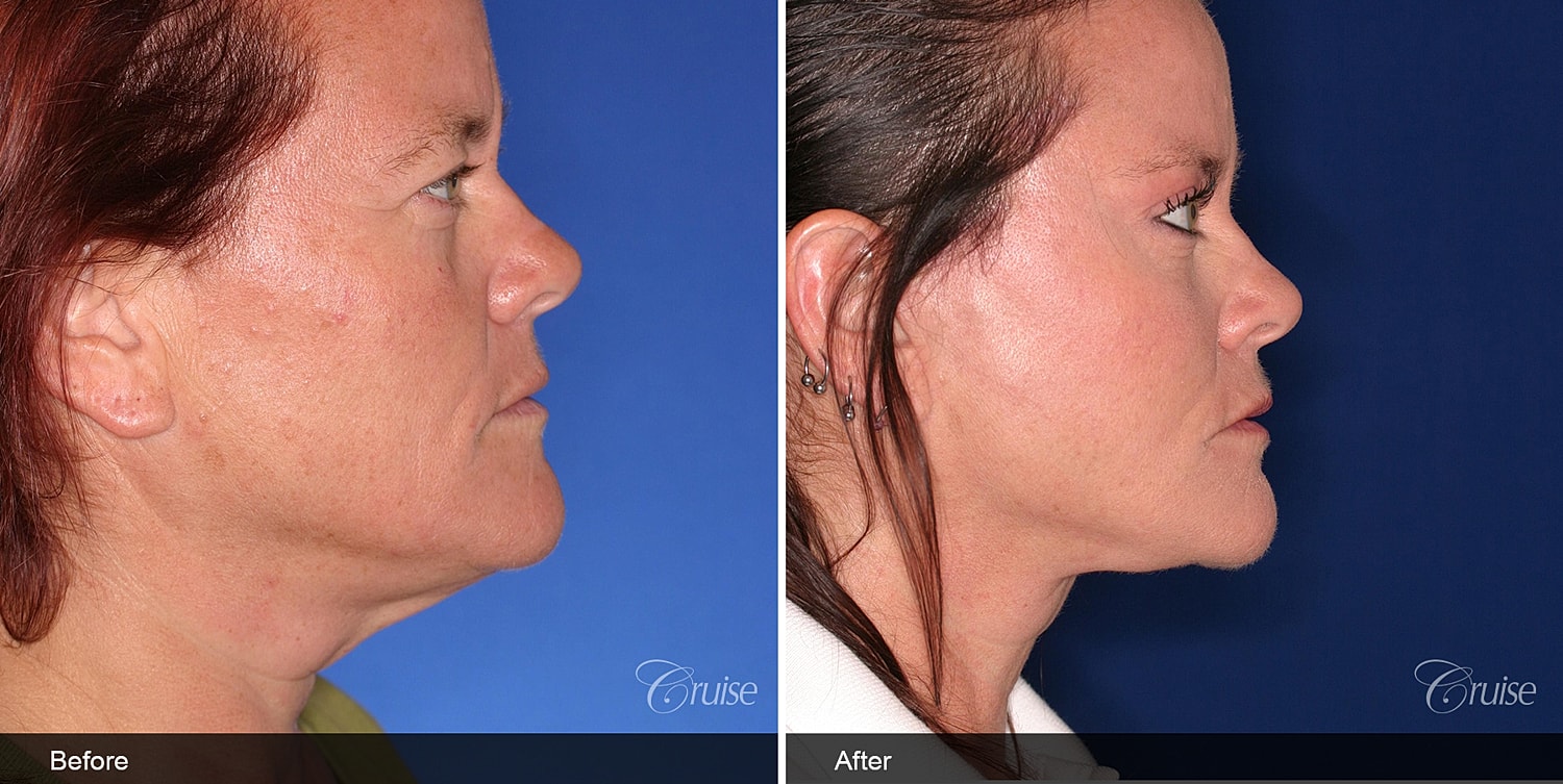 Neck Lift Before & After