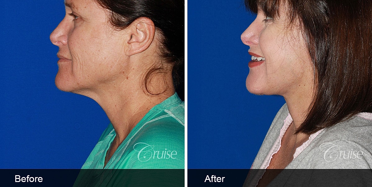 Neck Lift Before & After
