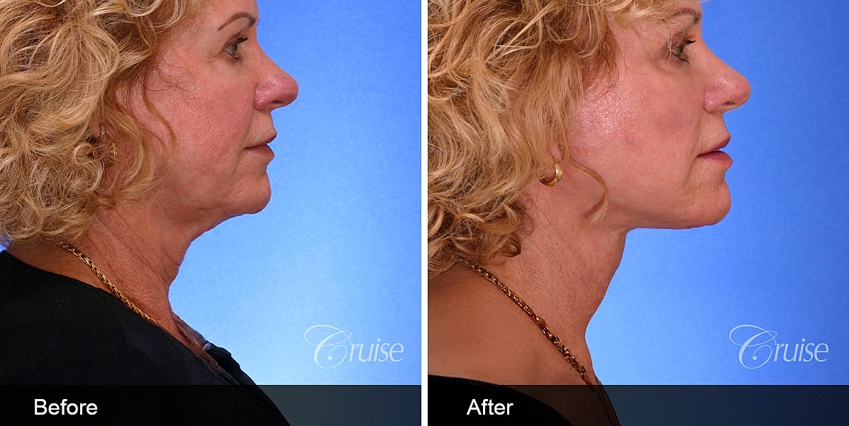 Neck Lift Before & After