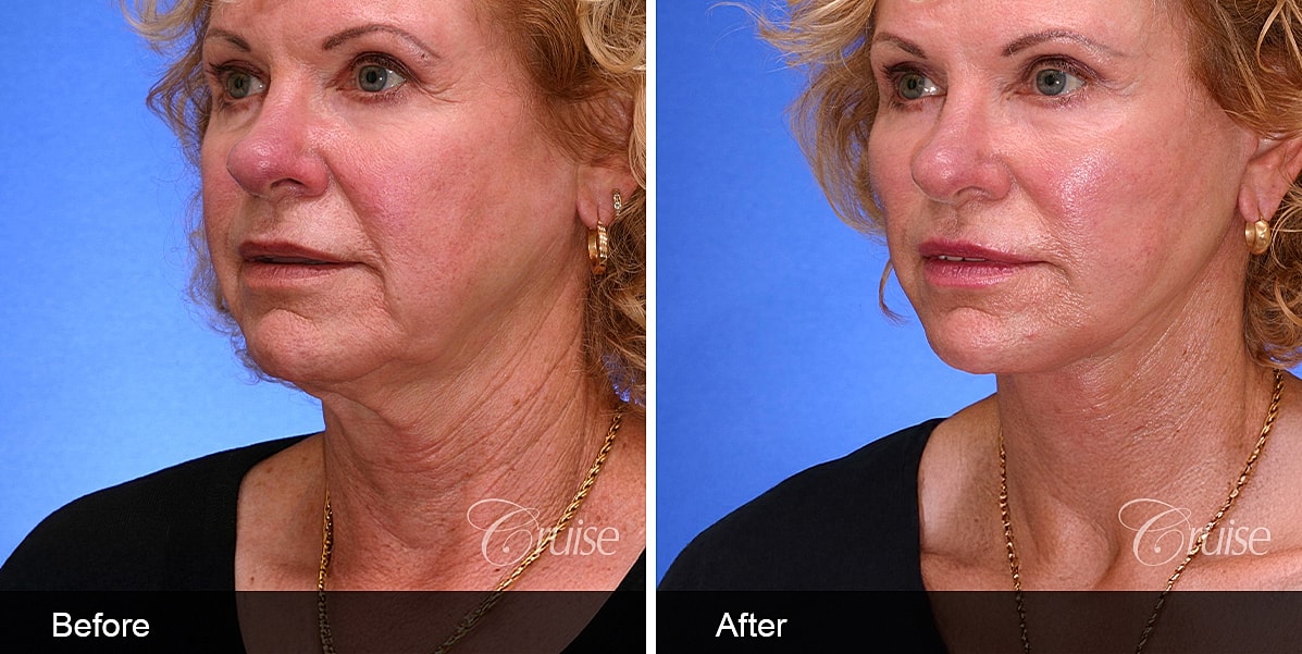 Neck Lift Before & After