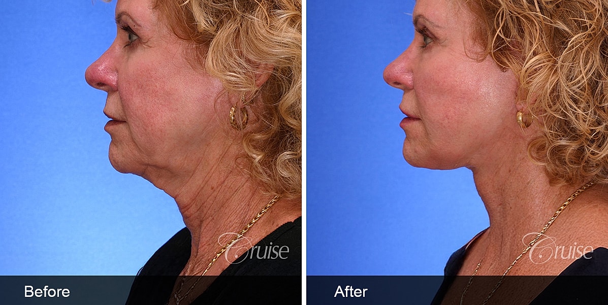 Neck Lift Before & After