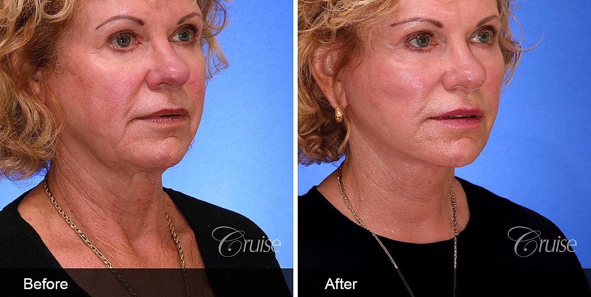 Neck Lift Before & After