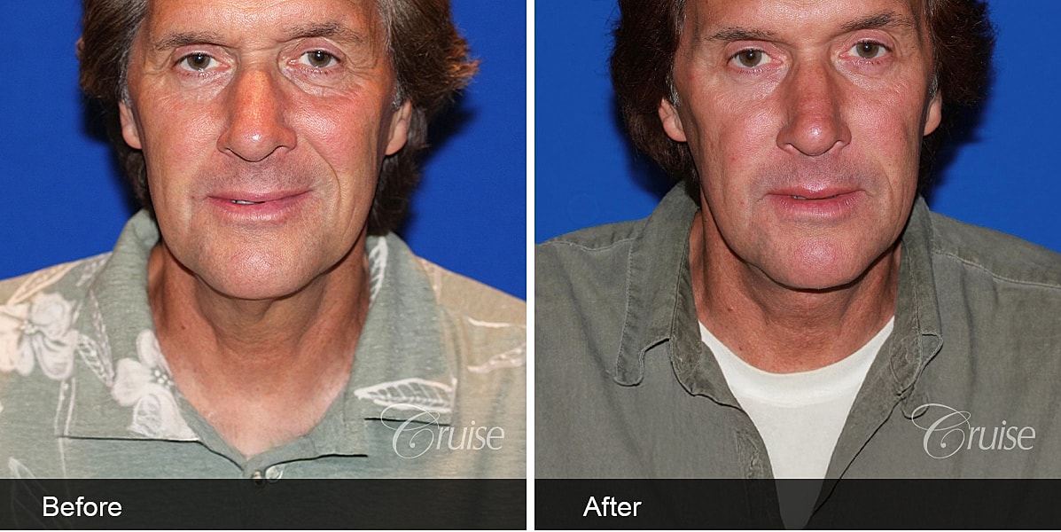 Neck Lift Before & After