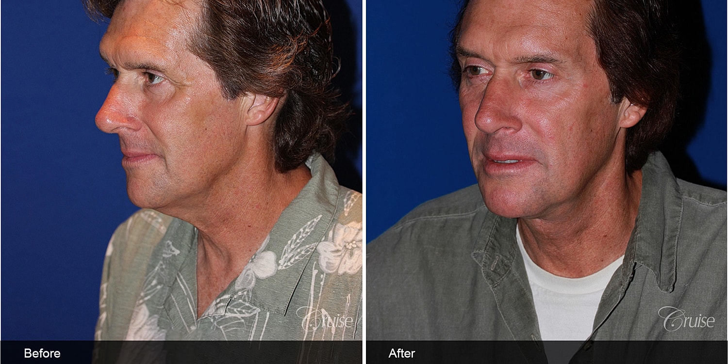 Neck Lift Before & After