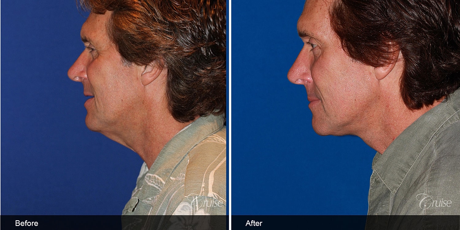 Neck Lift Before & After