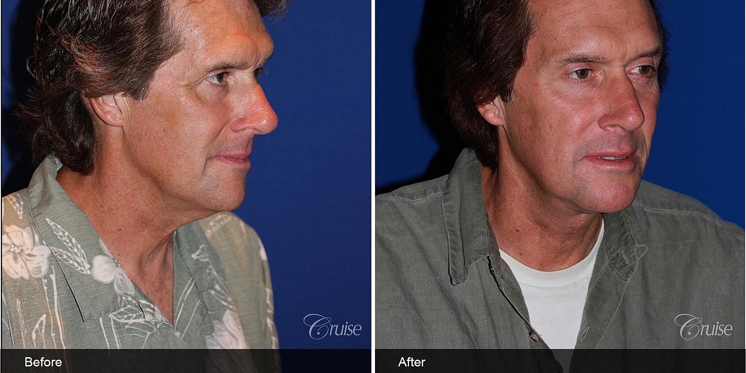 Neck Lift Before & After