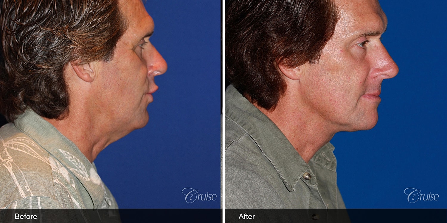 Neck Lift Before & After