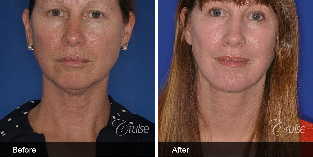 Neck Lift Before & After