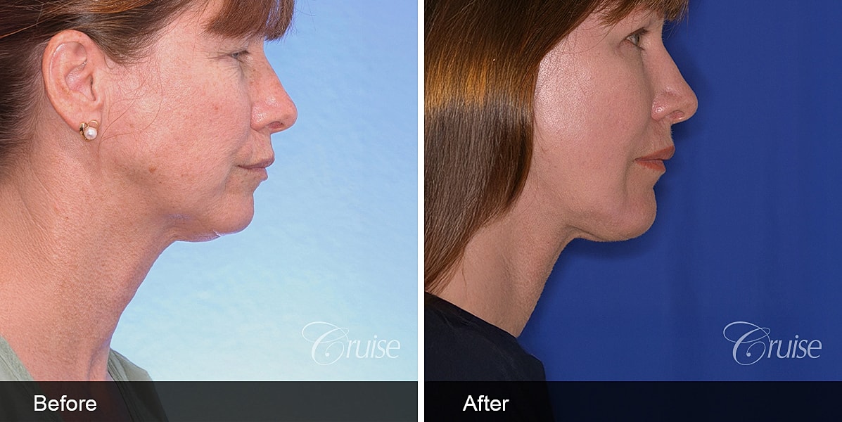 Neck Lift Before & After