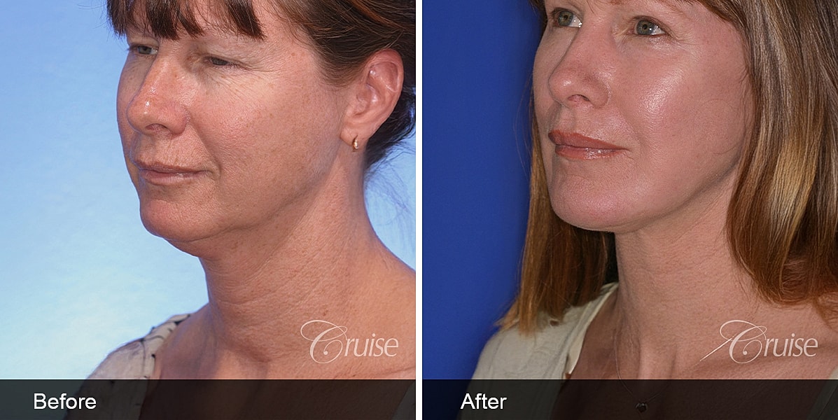 Neck Lift Before & After