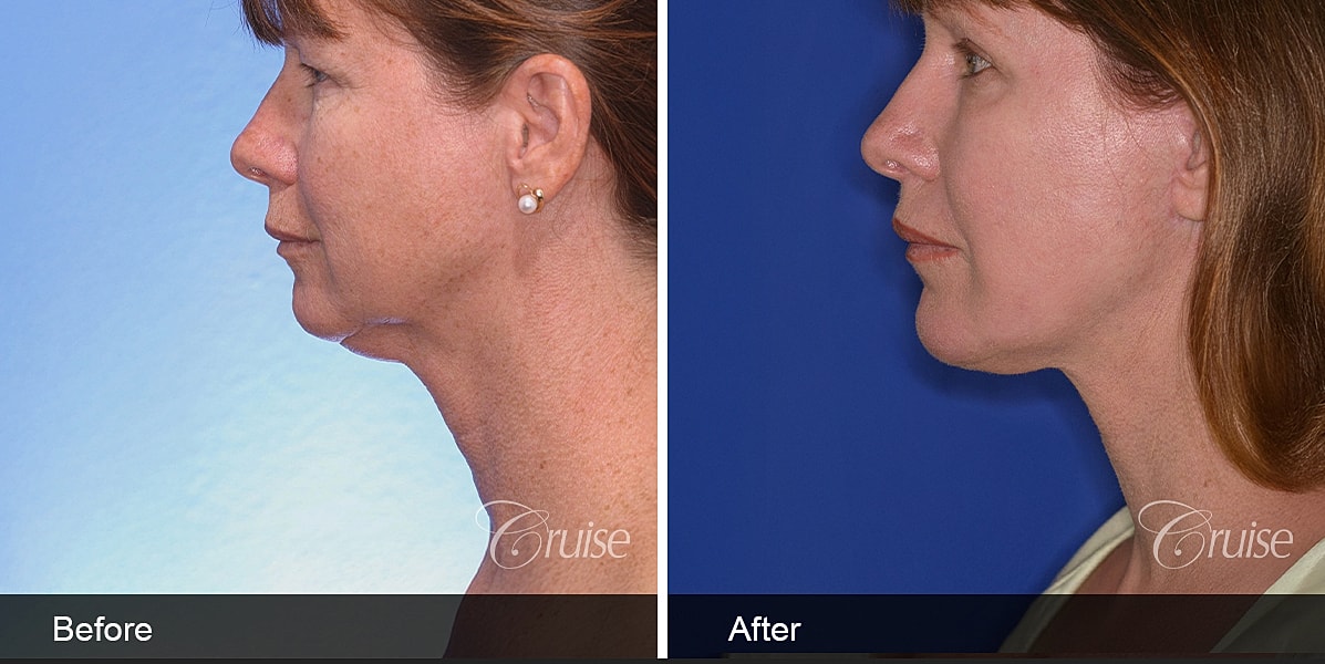 Neck Lift Before & After
