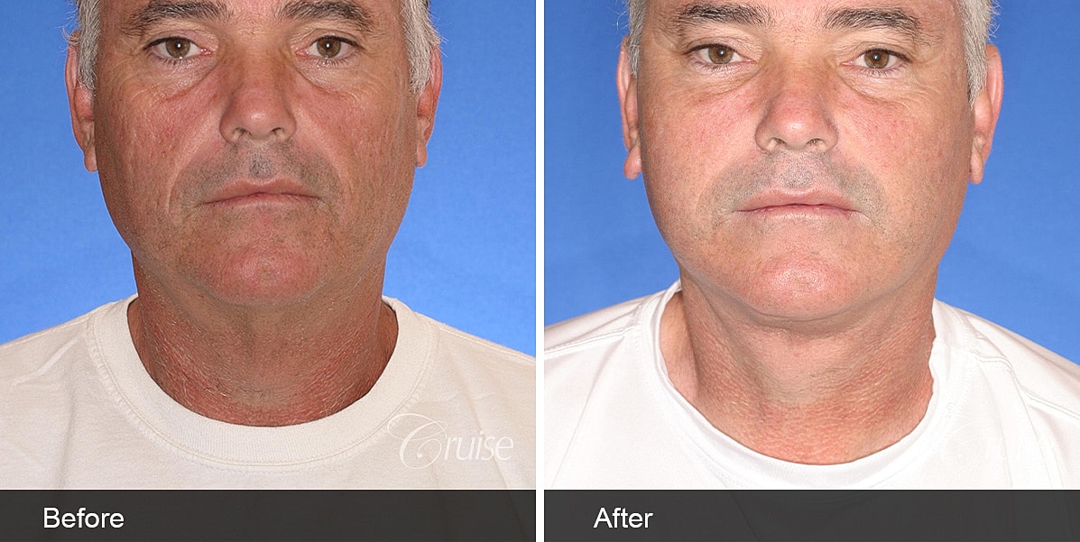 Neck Lift Before & After