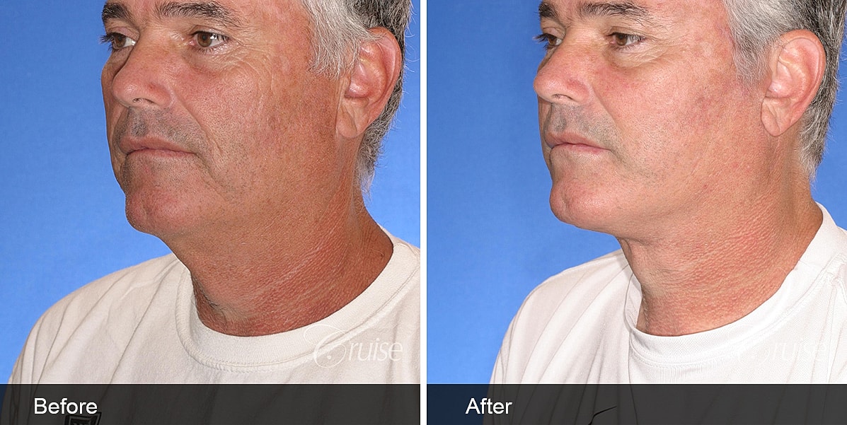 Neck Lift Before & After